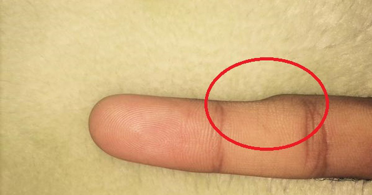 Tausende Menschen entdecken DIESE Delle am kleinen Finger DAS ist